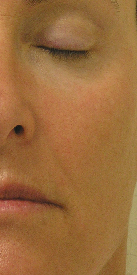 HydraFacial After 3