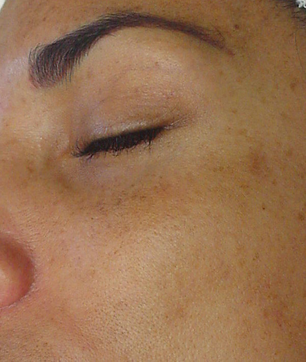 HydraFacial Before 2