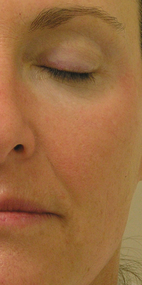 HydraFacial Before 3