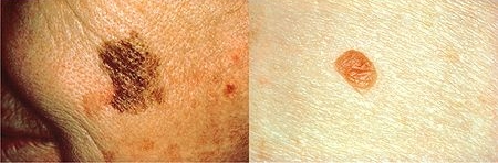 melanoma - d