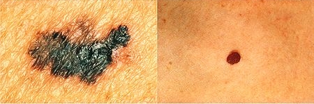 melanoma - v